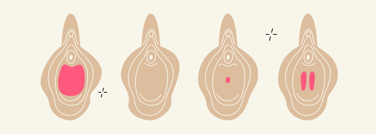 Septate Hymen What It Is and How a Hymenectomy Helps